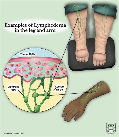 MoistureMeterD in Lymphedema 